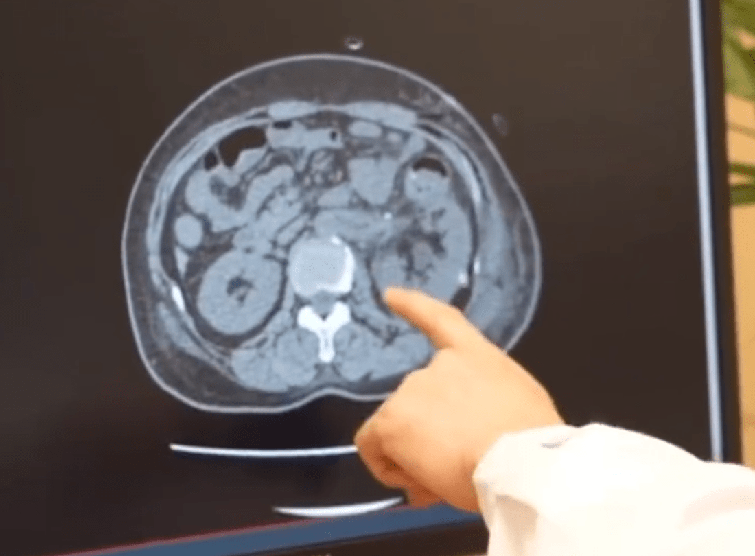 女子漏尿57年只因长了3个肾 ：手术切除