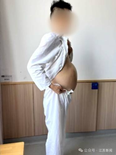 男子4个月没排便，腹中掏出20多斤、2米长“巨蟒”结肠 (图1)